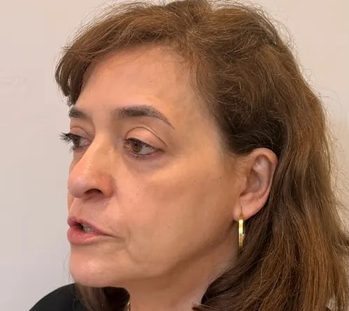 Perfil do rosto antes da harmonização facial, em cliente da Clínica Ornata em Caxias do Sul