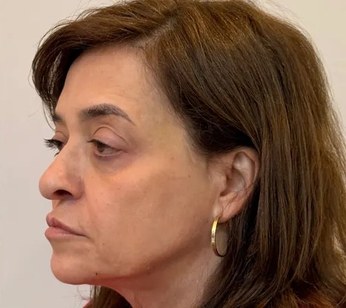 Perfil do rosto depois da harmonização facial, com contorno equilibrado
