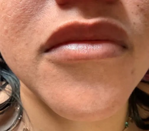 Lábios antes do preenchimento labial, em cliente da Clínica Ornata em Caxias do Sul
