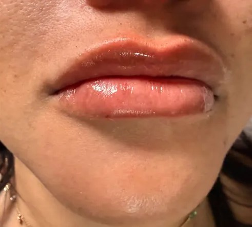 Lábios depois do preenchimento labial, com contorno definido