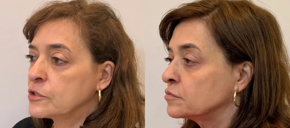 Antes e depois de harmonização facial