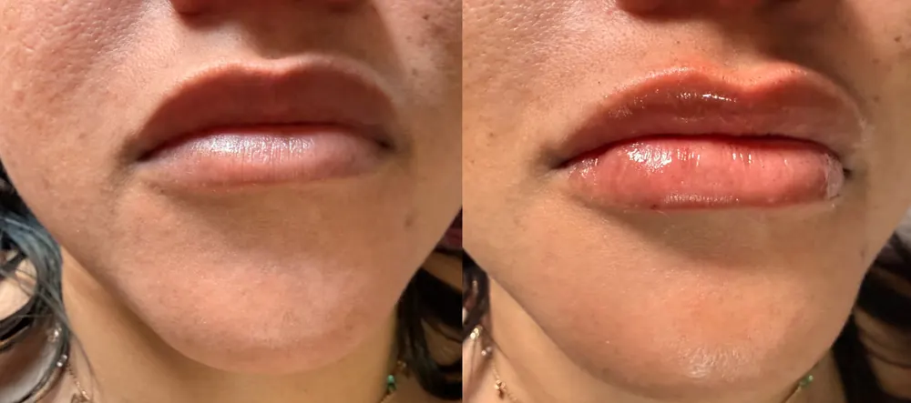 Antes e depois de preenchimento labial