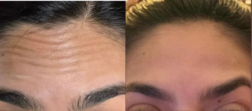 Antes e depois de toxina botulínica na testa